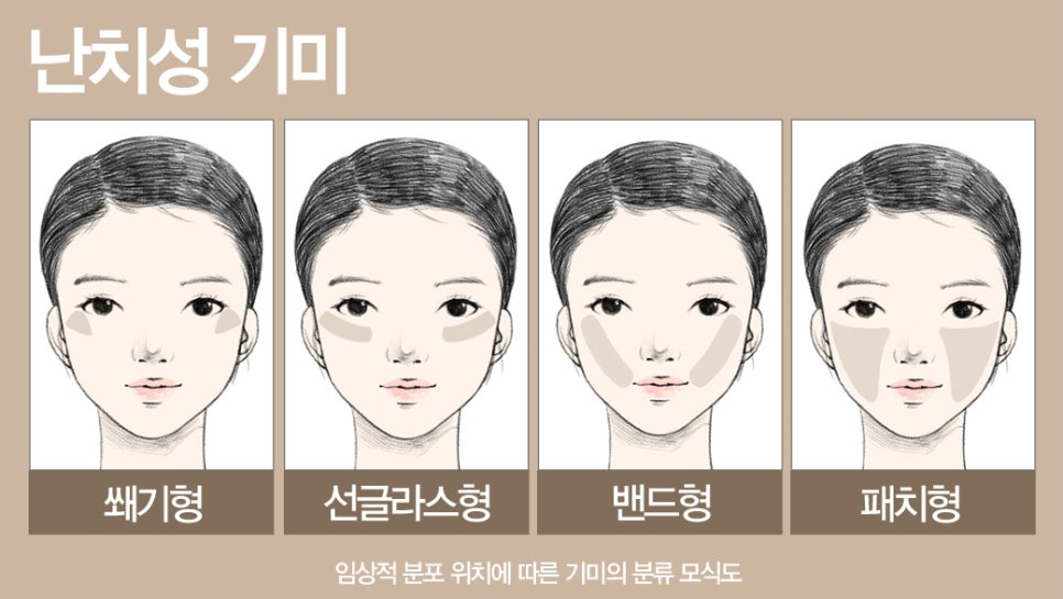 [기미의 원인] 잠실역  개원 22년 차 피부과 전문의 이야기 7 관련 이미지 1