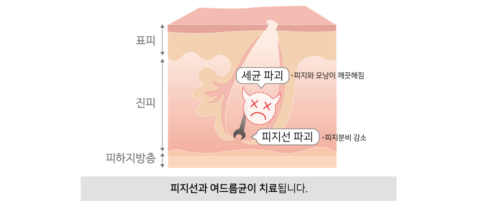 잠실여드름피부과 J핌클케어 여드름치료 관련 이미지 7
