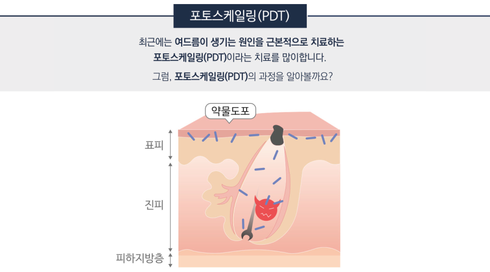 잠실여드름피부과 J핌클케어 여드름치료 관련 이미지 4