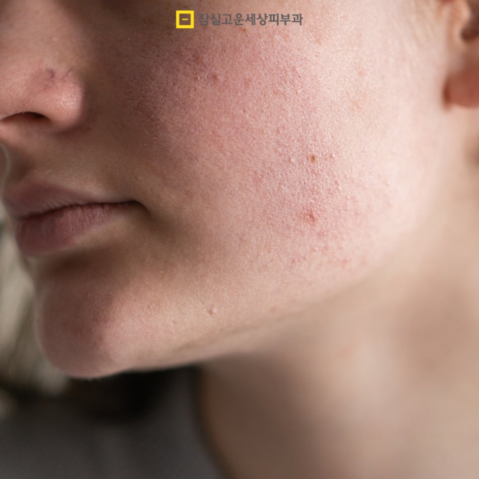 수분부족형 지성, 환절기에 더 건조해지는 이유 관련 이미지 6