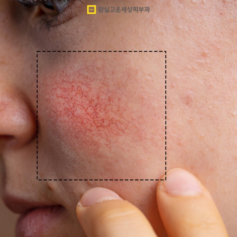 안면홍조, 왜 사라졌다가 다시 심해질까? 관련 이미지 2