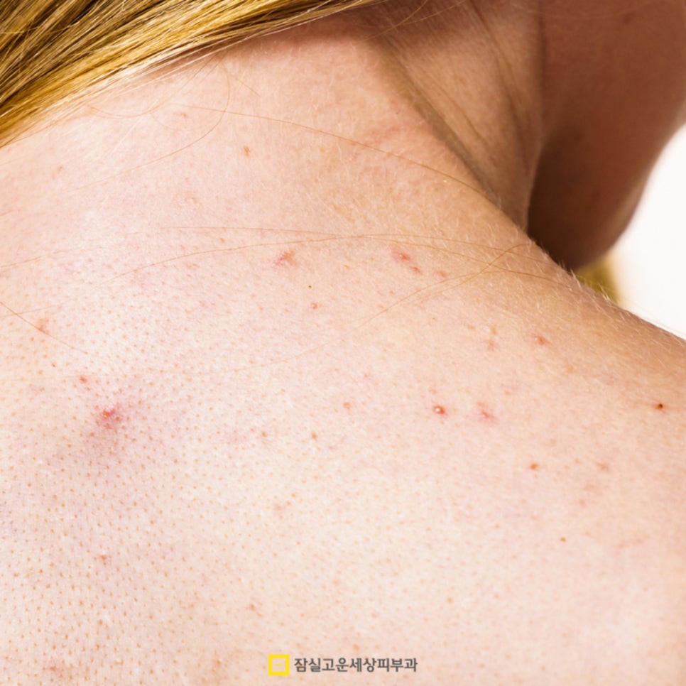 여름철 등드름과 가드름 완전 정복! 시원한 옷차림을 위한 완벽 가이드 관련 이미지 2