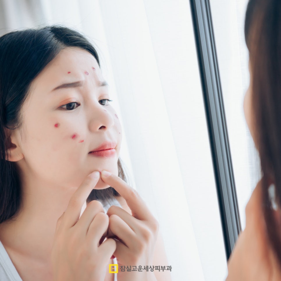 여드름 흉터, 시간이 지나도 사라지지 않는 이유 관련 이미지 3