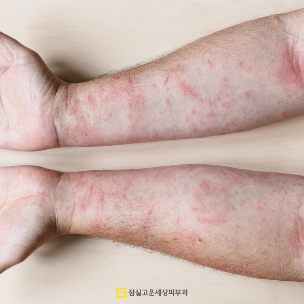 여름철 피부 발진, 제대로 알고 예방하는 방법 관련 이미지 4