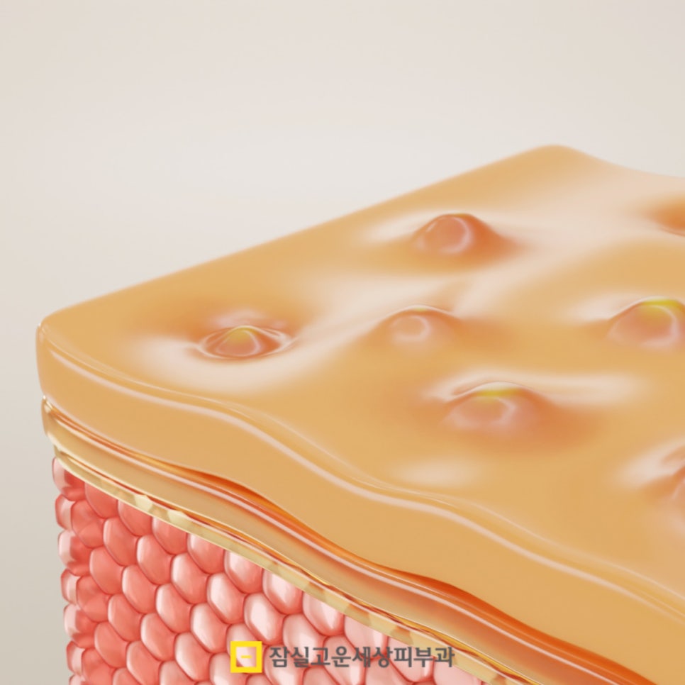 왜 환절기엔 여드름이 더 심해질까요? 관련 이미지 3