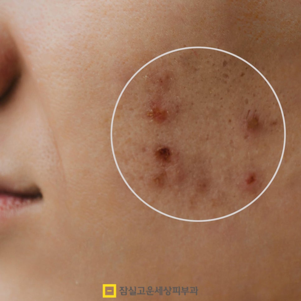 여드름 흉터 치료, 피부 타입별로 접근이 달라야 하는 이유 관련 이미지 7