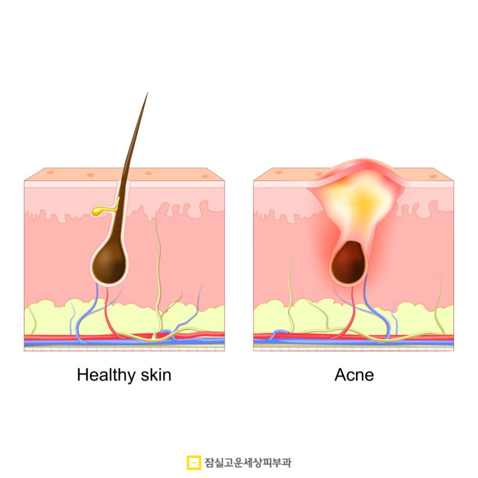 여드름, 반복되는 고민에서 벗어나려면? 관련 이미지 3