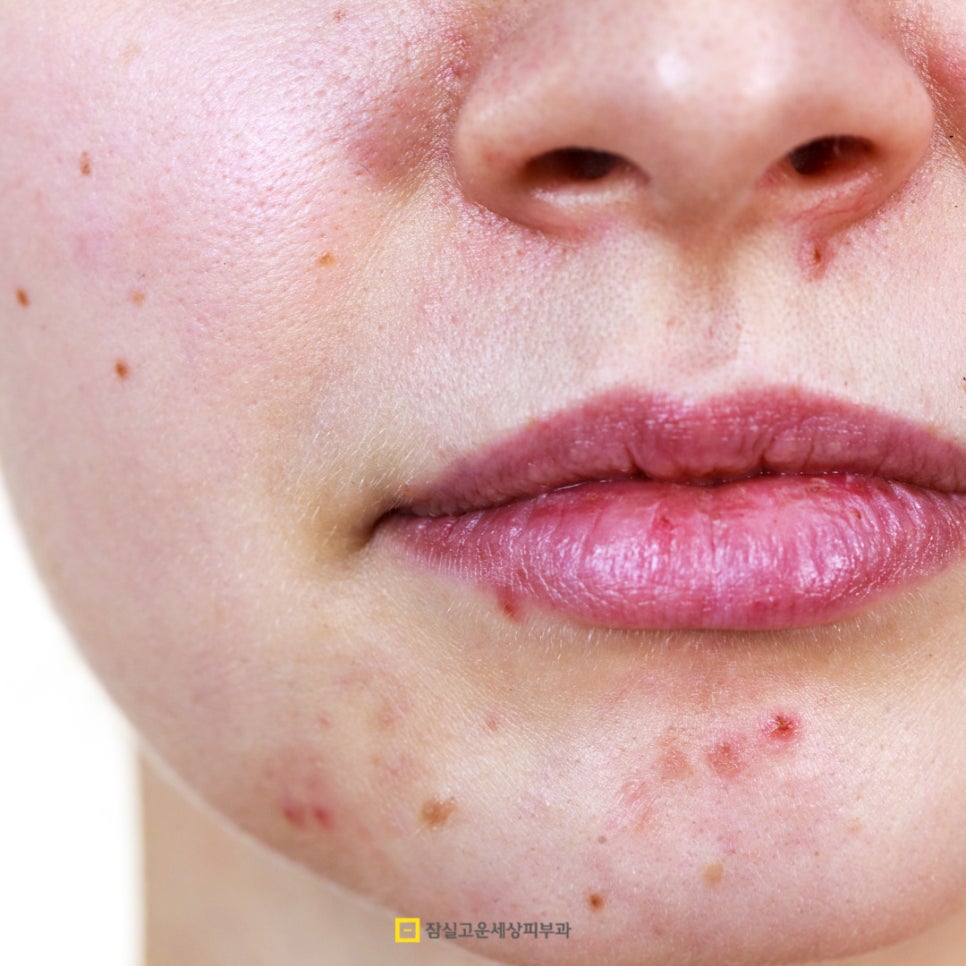 [잠실고운세상피부과] 여드름흉터, 골든타임 놓치지 않는 체계적 관리법 관련 이미지 3