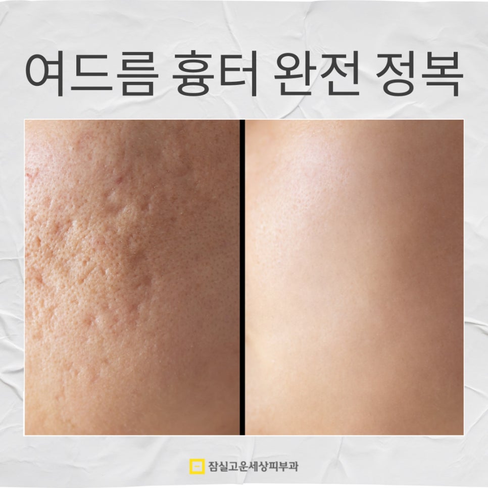 여드름 흉터, 시간이 지나도 사라지지 않는 이유 관련 이미지 1