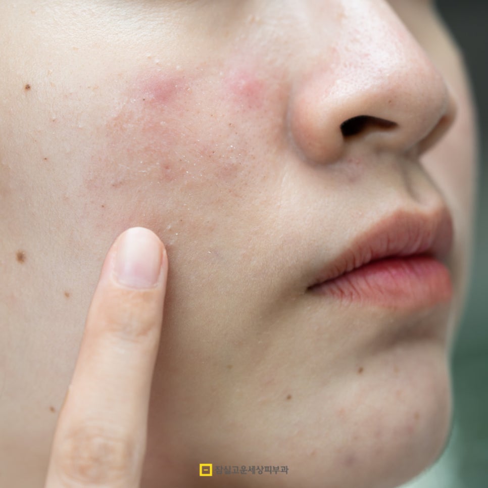 뾰루지 A to Z, 함부로 짜지 말고 제대로 구별하고 케어하세요! 관련 이미지 2