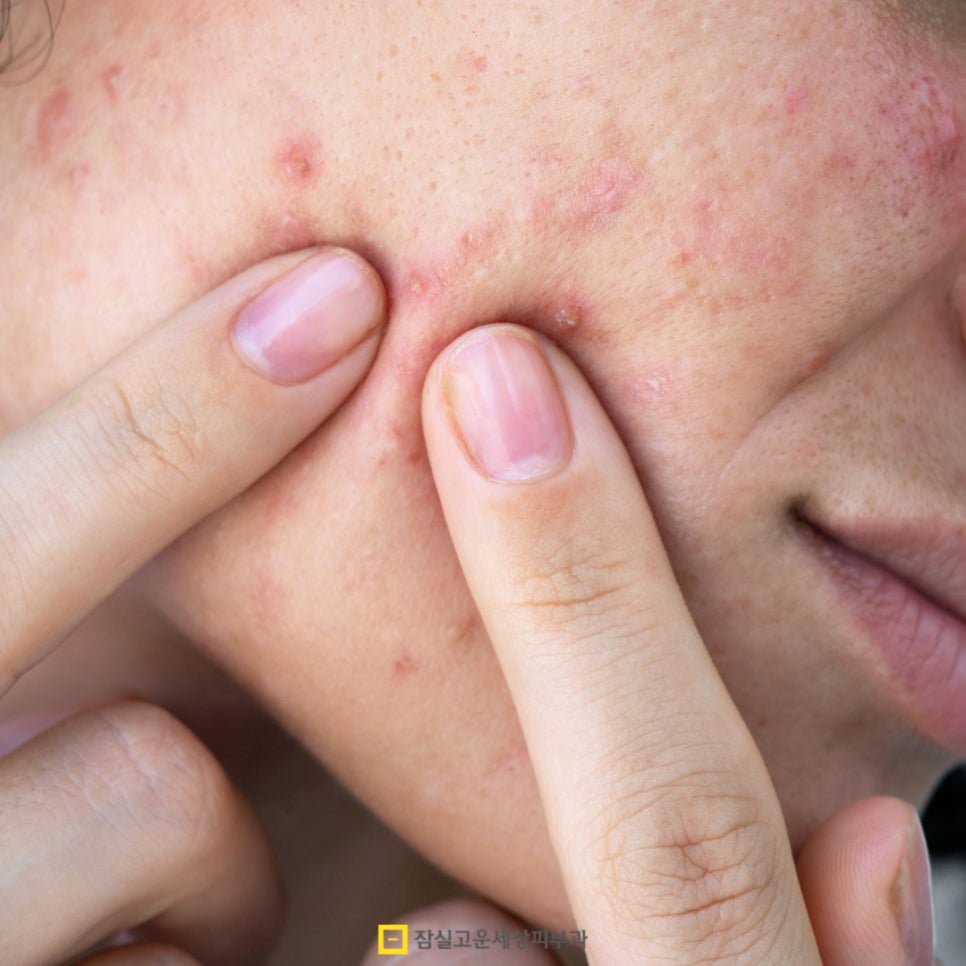 여드름, 근본부터 다시 보는 피부 루틴 관련 이미지 3