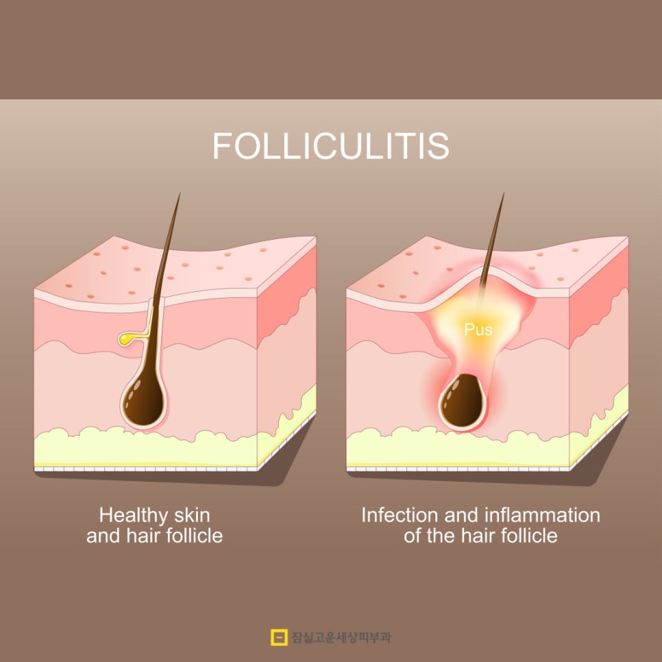 뾰루지 A to Z, 함부로 짜지 말고 제대로 구별하고 케어하세요! 관련 이미지 4