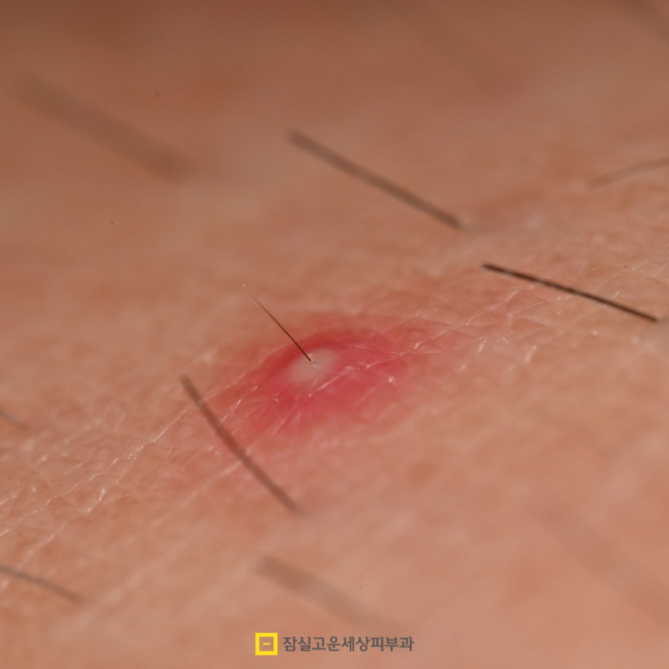 여름철 피부 발진, 제대로 알고 예방하는 방법 관련 이미지 7