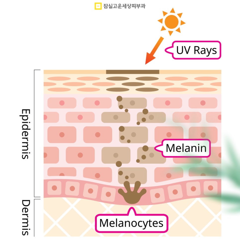 기미 원인부터 치료 방법, 예방이 중요한 이유까지 관련 이미지 2