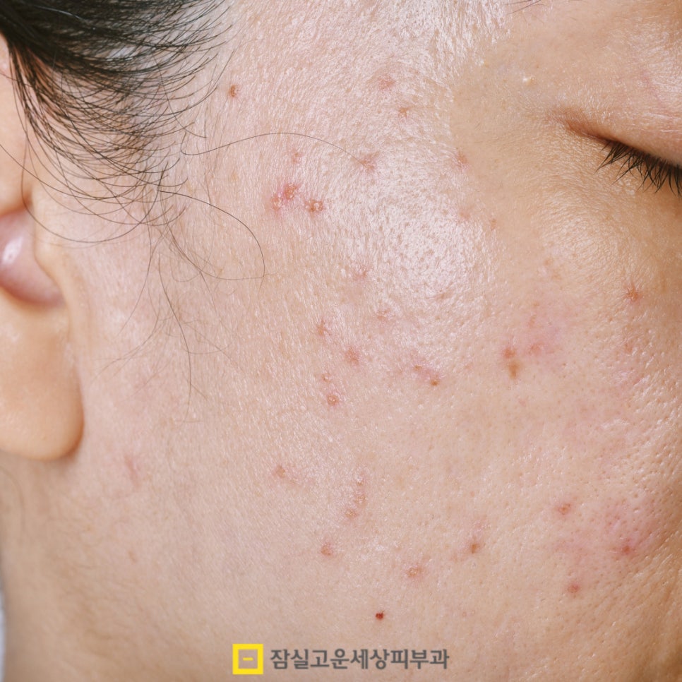 피부과 여드름 치료, 얼마나 오래 다녀야 하나요? 관련 이미지 2