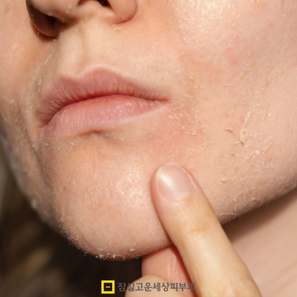 피부 건조, 원인부터 관리까지 알아보기 관련 이미지 2