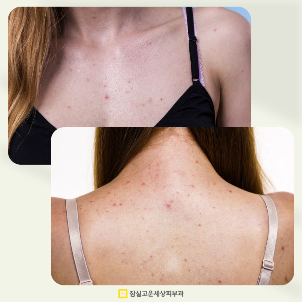 여드름, 근본부터 다시 보는 피부 루틴 관련 이미지 2