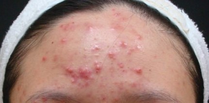 잠실피부관리 메디컬스킨케어로 연휴 후유증 극복! (잠실고운세상피부과/잠실피부과/여드름치료/메디컬스킨케어) 관련 이미지 5