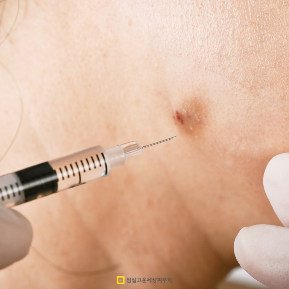 성인 여드름, 사춘기 때 끝난 줄 알았는데 다시 시작된 이유 관련 이미지 8