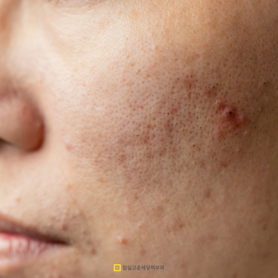 뾰루지 A to Z, 함부로 짜지 말고 제대로 구별하고 케어하세요! 관련 이미지 3