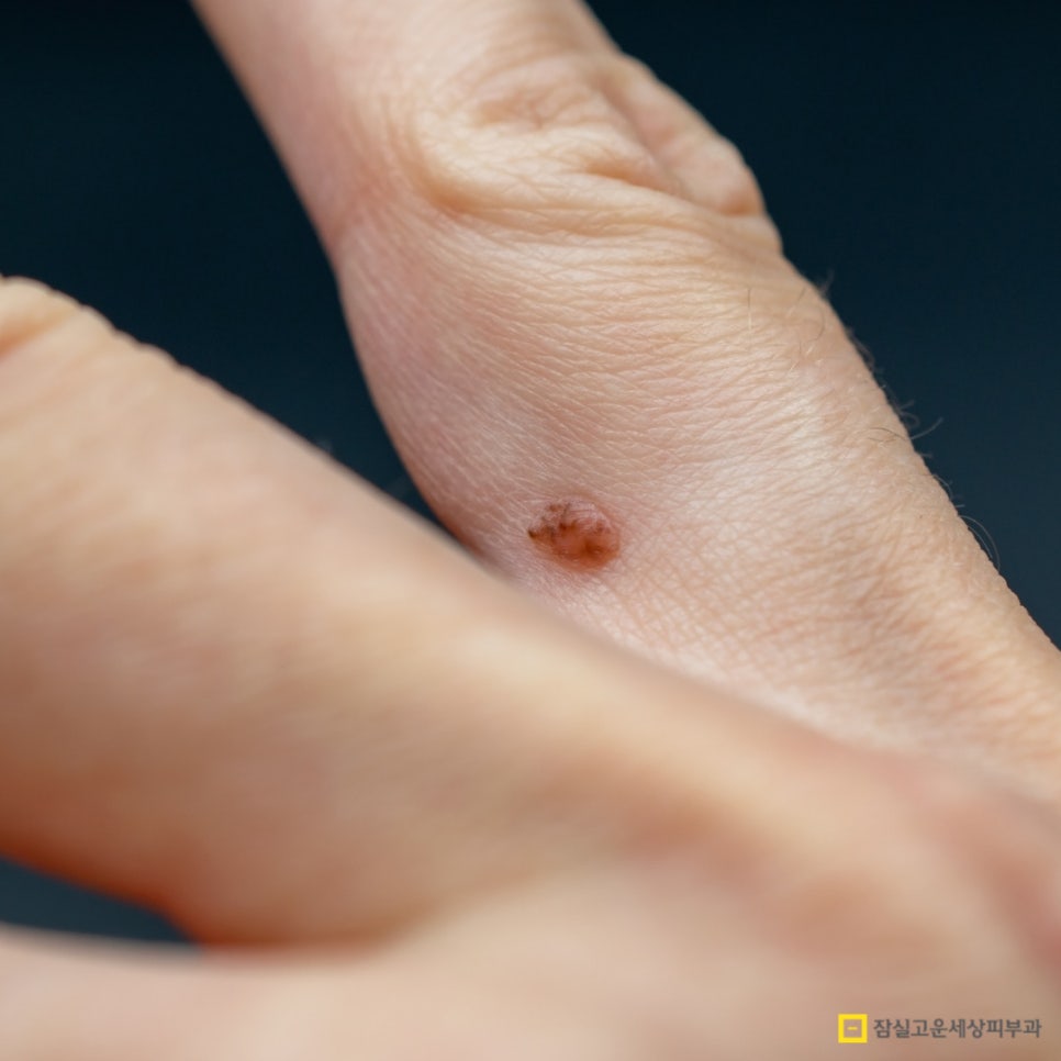 사마귀, 검버섯, 흑자 구분법 및 치료 가이드 관련 이미지 3