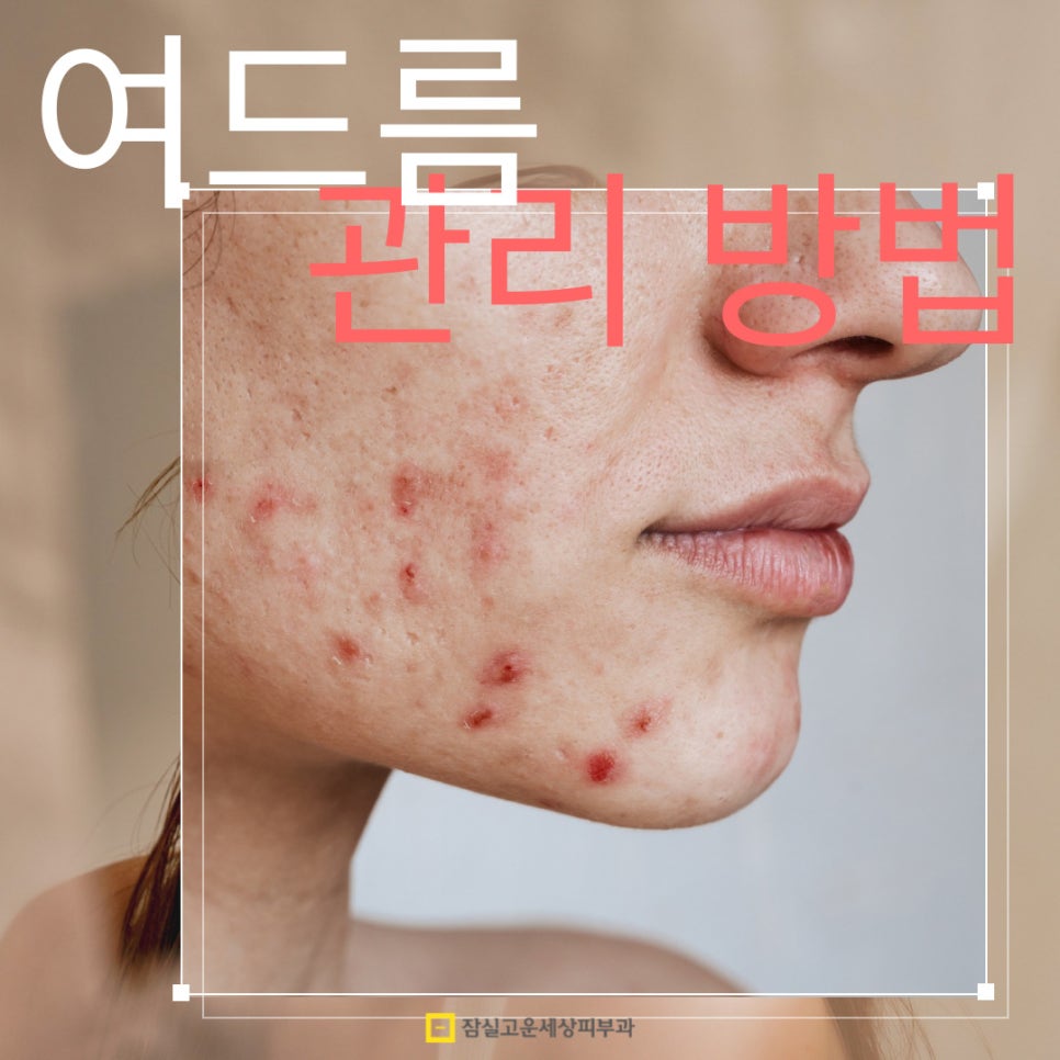 여드름, 이렇게 관리하세요! 관련 이미지 1