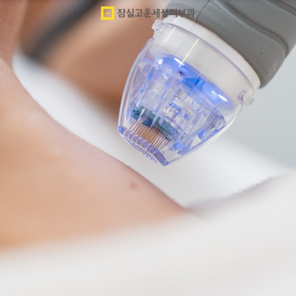 기미 치료의 올바른 접근 방법 관련 이미지 5