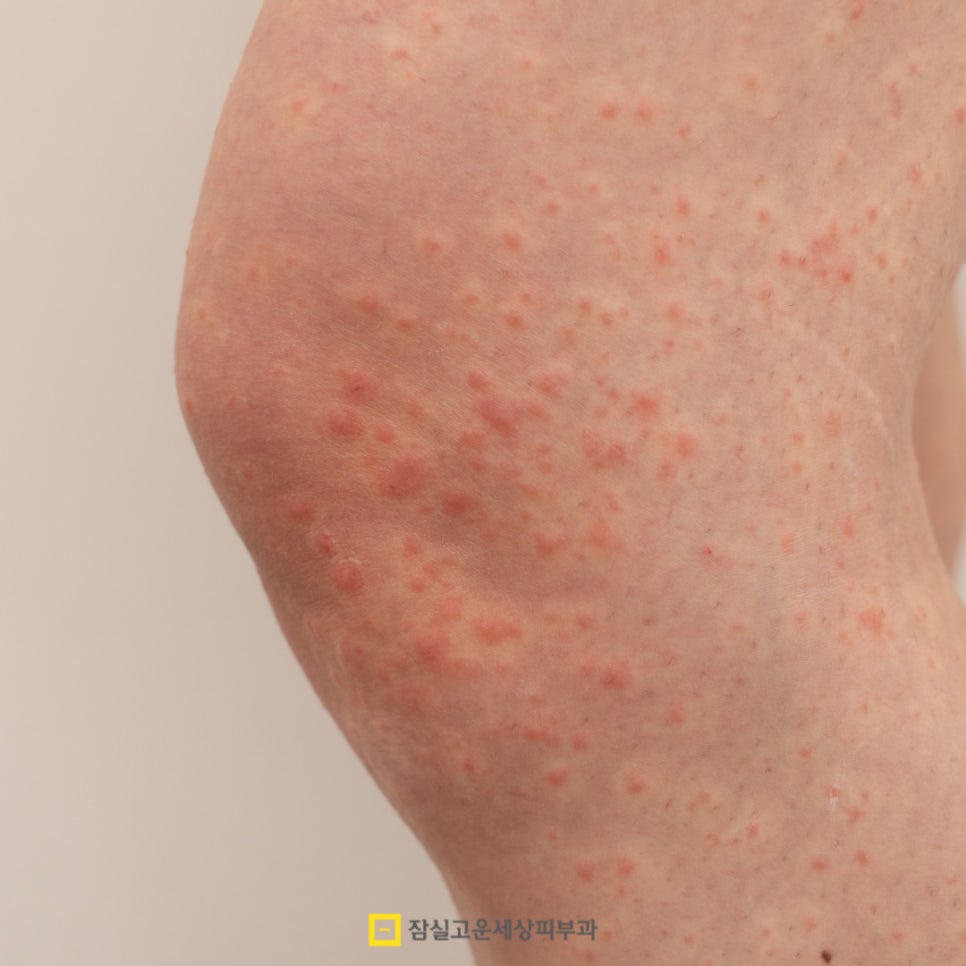 여름철 피부 발진, 제대로 알고 예방하는 방법 관련 이미지 5