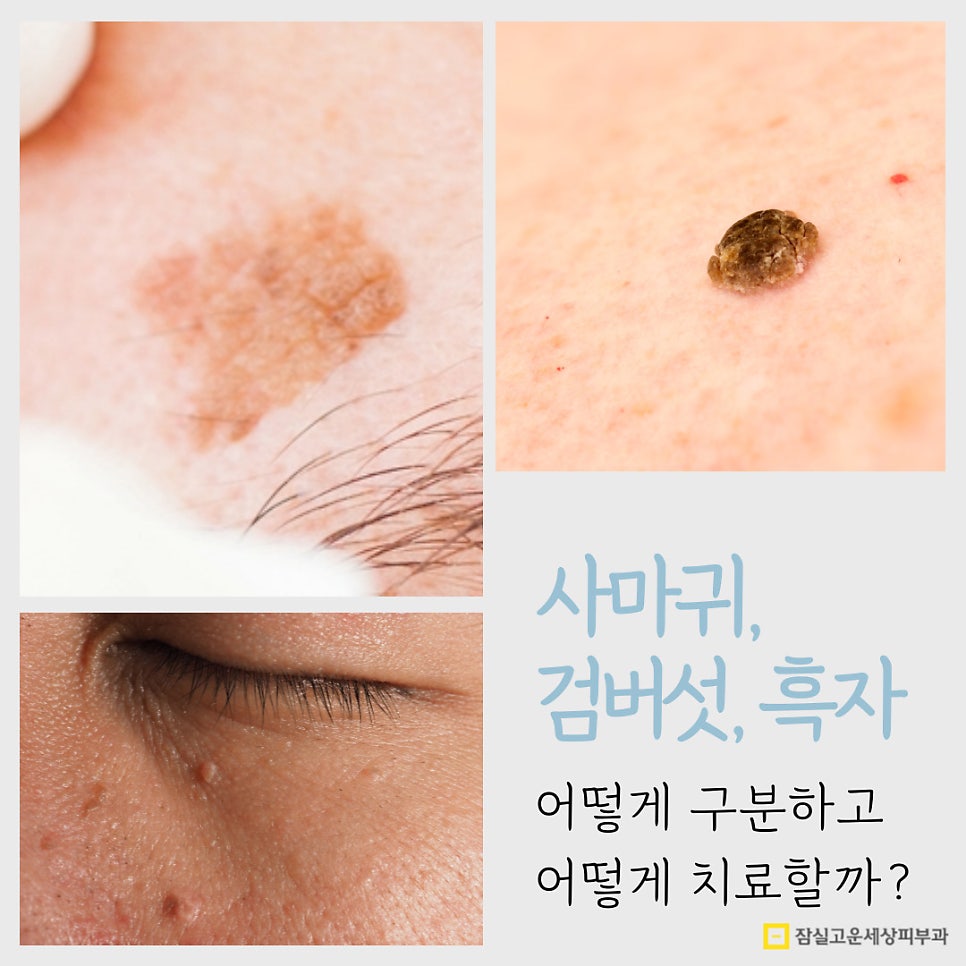 사마귀, 검버섯, 흑자 구분법 및 치료 가이드 관련 이미지 1