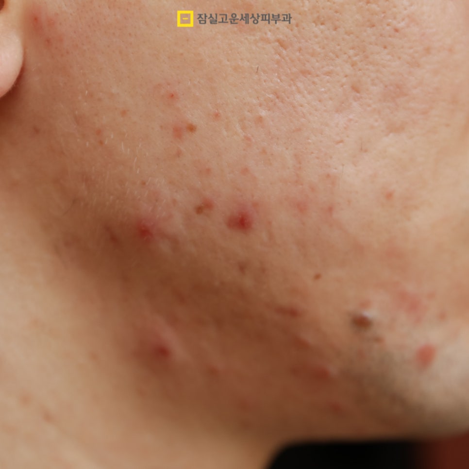 여드름 Q&A, 주요 궁금증들 관련 이미지 2