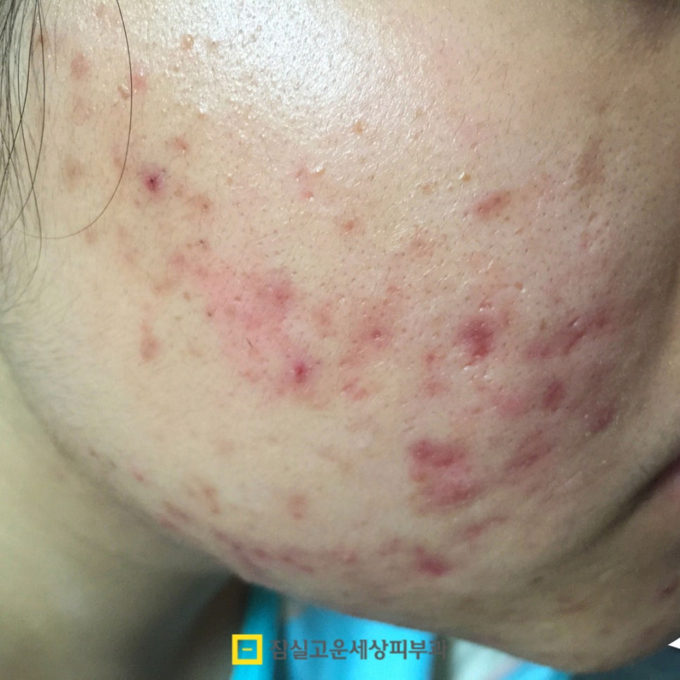 우리 아이 사춘기 여드름, 언제부터 어떻게 관리해야 할까? 관련 이미지 6