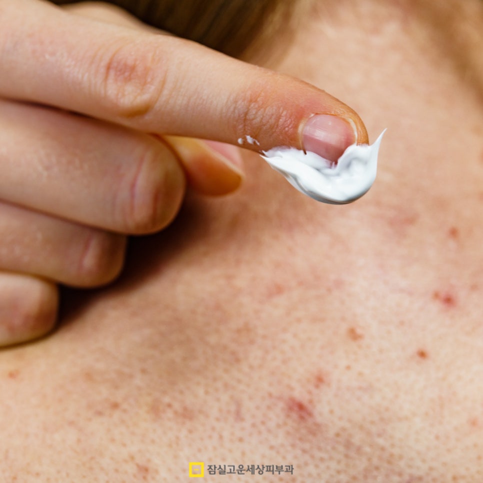 여드름, 근본부터 다시 보는 피부 루틴 관련 이미지 4