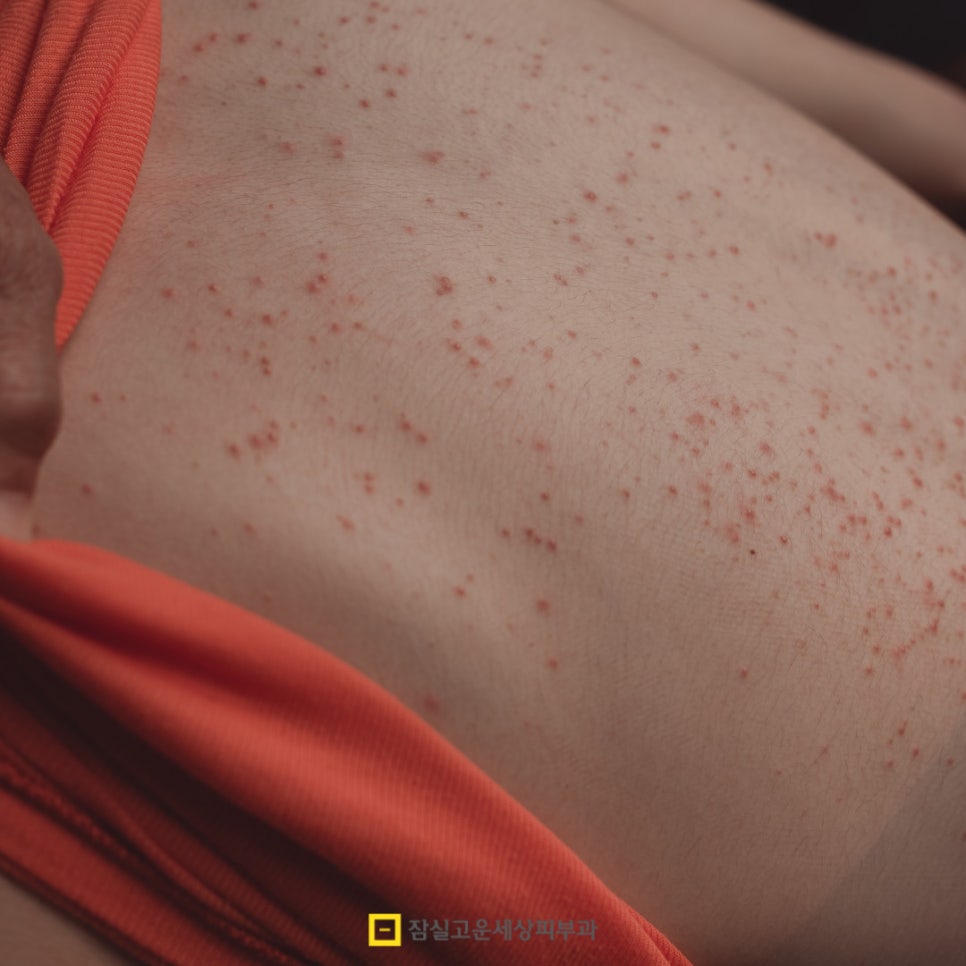 여름철 피부 발진, 제대로 알고 예방하는 방법 관련 이미지 3