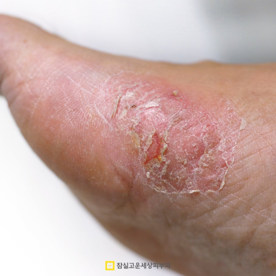 여름철 피부 발진, 제대로 알고 예방하는 방법 관련 이미지 8