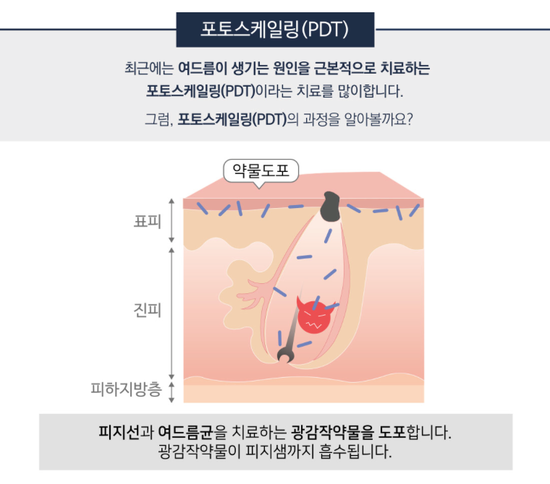 잠실여드름피부과 J핌클케어입니다 (잠실고운세상피부과/잠실역피부과) 관련 이미지 5