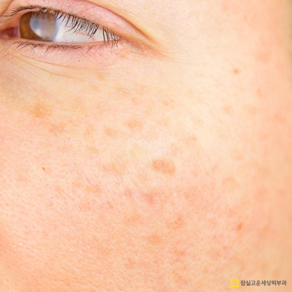 사마귀, 검버섯, 흑자 구분법 및 치료 가이드 관련 이미지 6