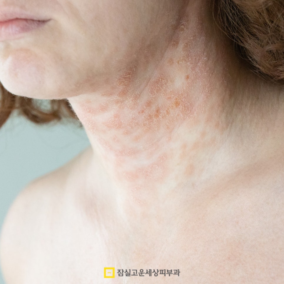 아토피 관리, 습관에서 시작되는 건강한 피부 관련 이미지 5