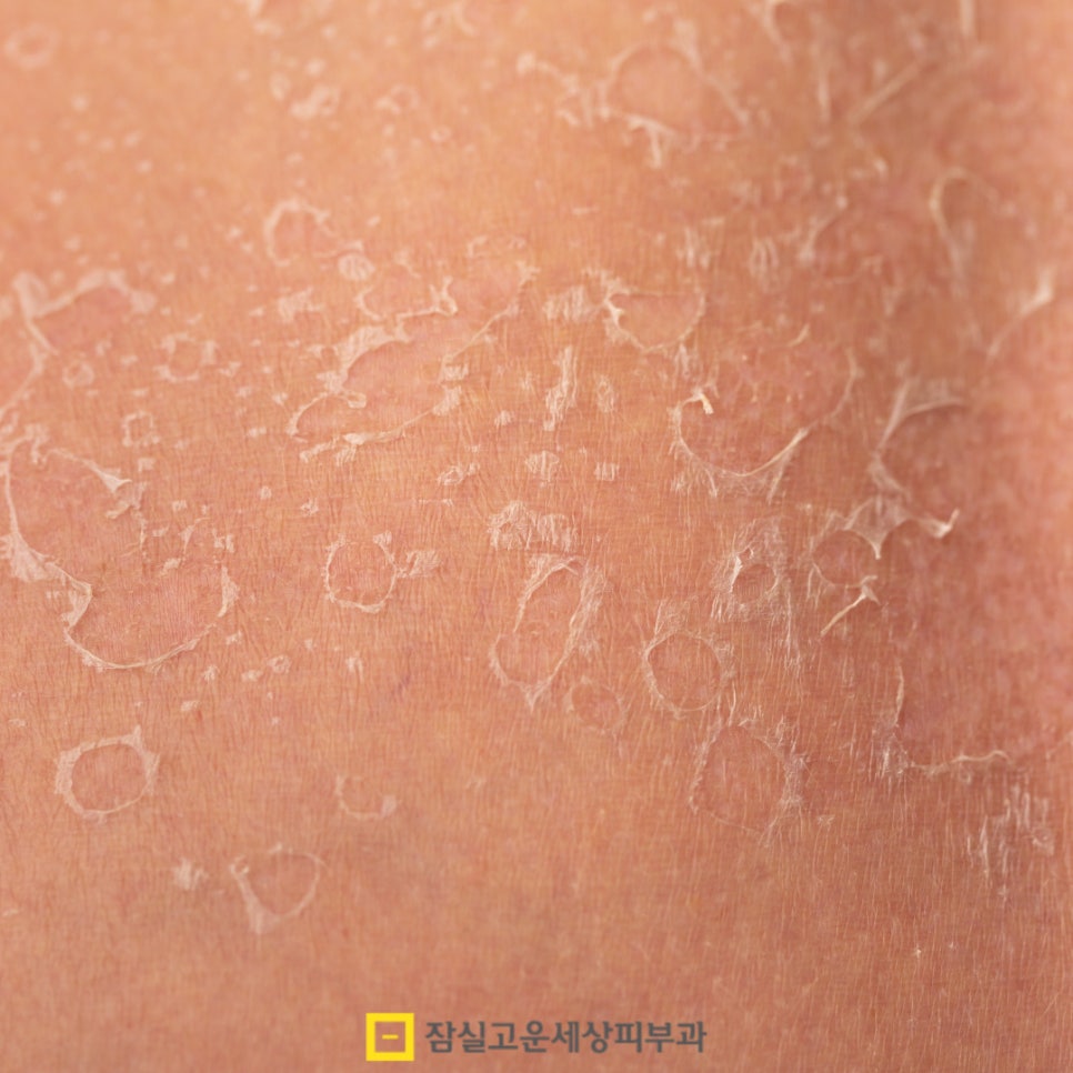 피부 건조, 원인부터 관리까지 알아보기 관련 이미지 8