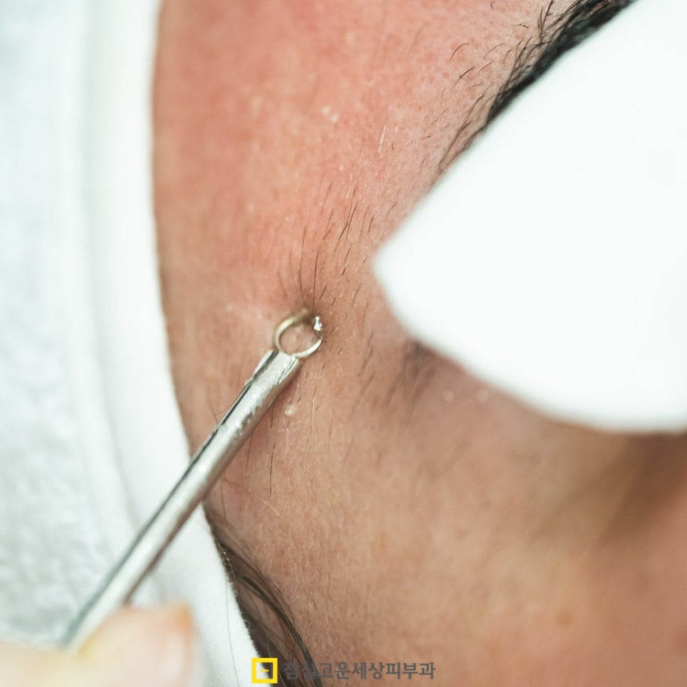 여드름, 흉터까지 번지기 전에 알아야 할 진실 관련 이미지 5