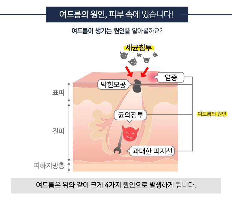 지속되는 여드름, 원인과 치료 방법 관련 이미지 3
