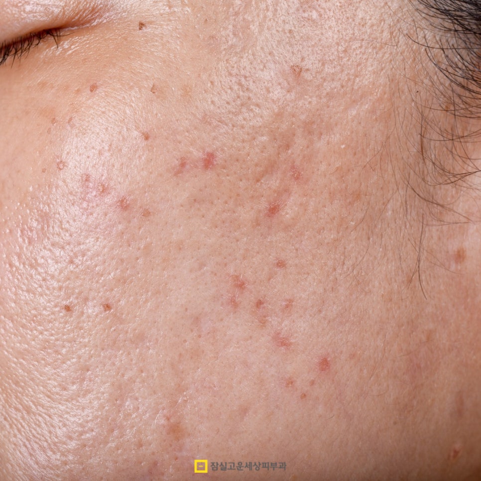 성인 여드름, 사춘기 때 끝난 줄 알았는데 다시 시작된 이유 관련 이미지 2