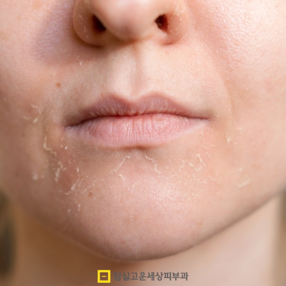 환절기 피부관리법, 피부가 보내는 신호에 귀 기울이기 관련 이미지 2