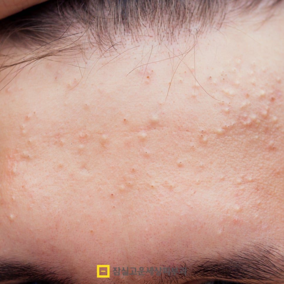 여드름 압출, 왜 해야 하고 어떻게 해야 안전할까? 관련 이미지 4