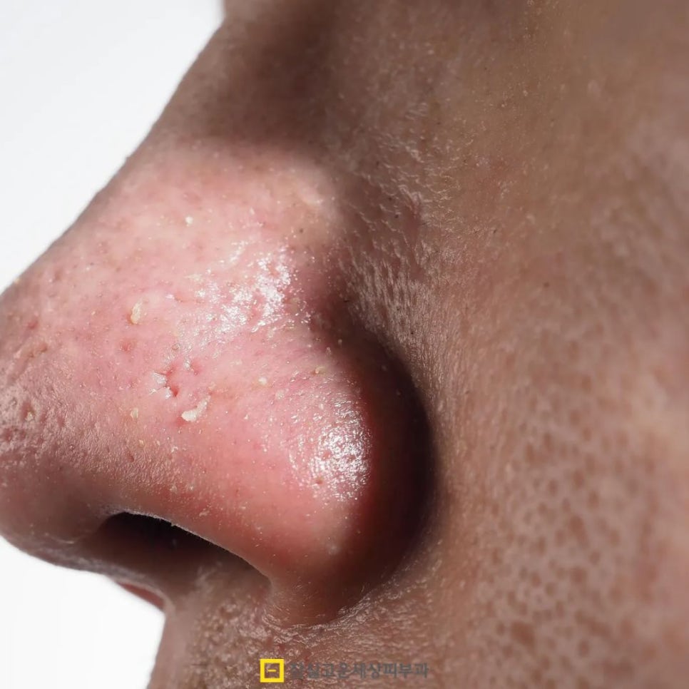 건조한데 기름지는 피부? 손건조부터 장벽까지, 타입별 진단 가이드 관련 이미지 8