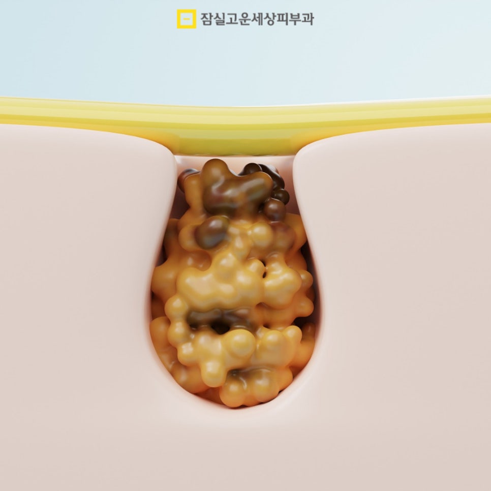 늘어난 모공, 정말 줄일 수 있을까? 관련 이미지 3