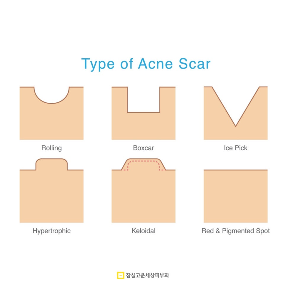 [잠실고운세상피부과] 여드름흉터, 골든타임 놓치지 않는 체계적 관리법 관련 이미지 2