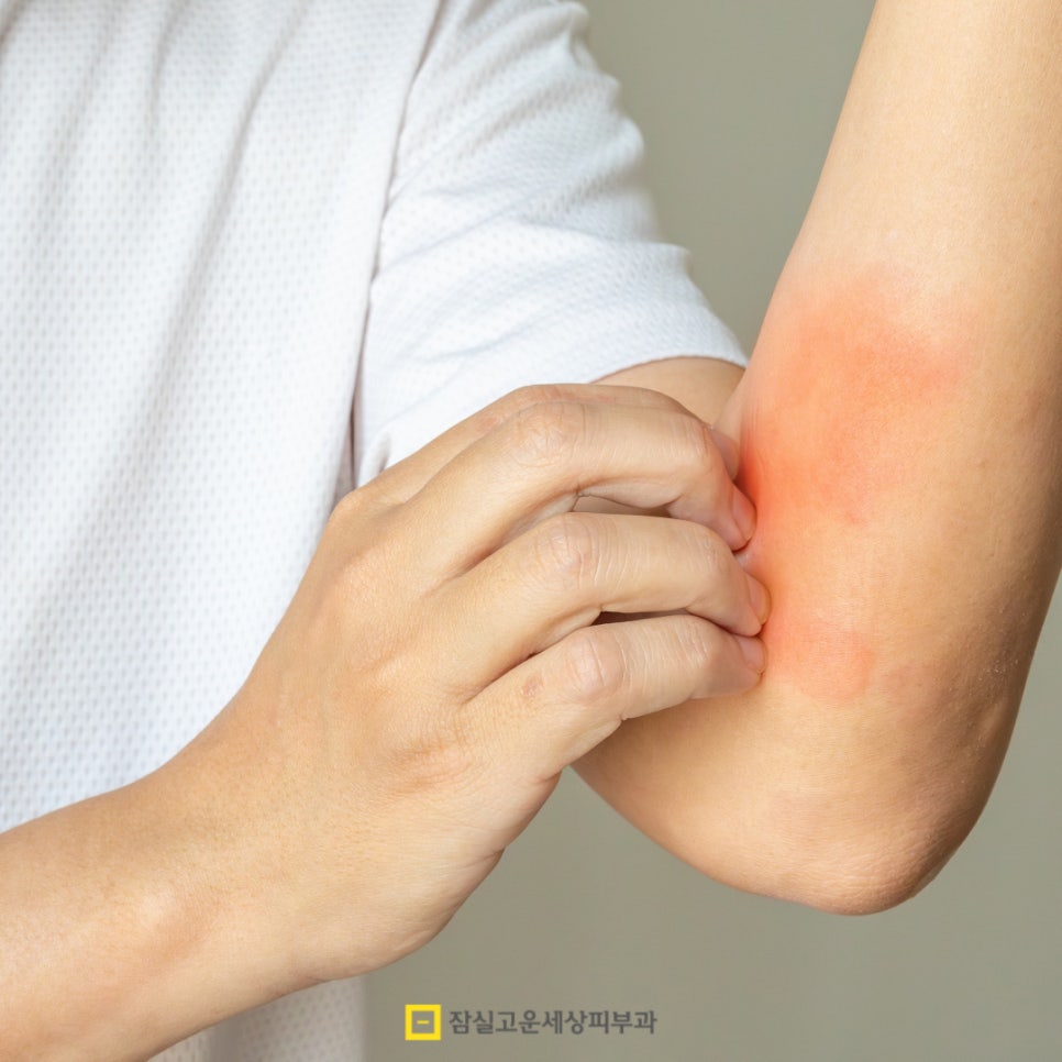 여름철 피부 발진, 제대로 알고 예방하는 방법 관련 이미지 11
