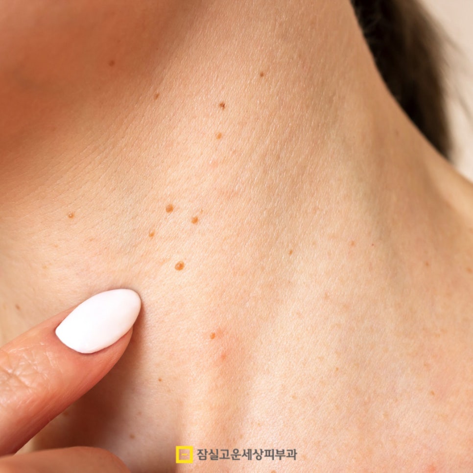피부에 나타나는 작은 돌기, 편평사마귀에 대해 알아야 할 모든 것 관련 이미지 2
