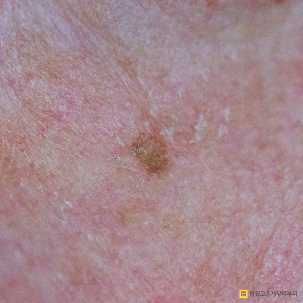 사마귀, 검버섯, 흑자 구분법 및 치료 가이드 관련 이미지 4