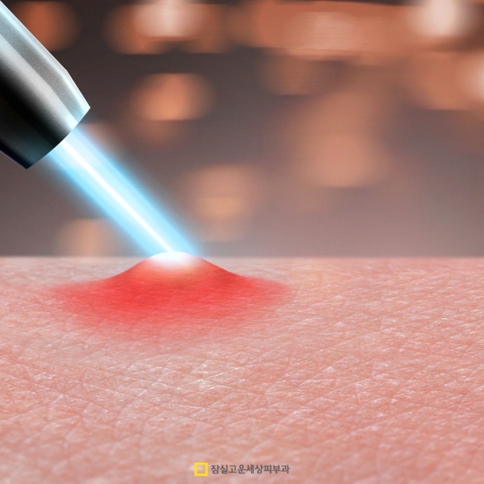 여드름, 일상부터 전문가 케어까지! 관련 이미지 7